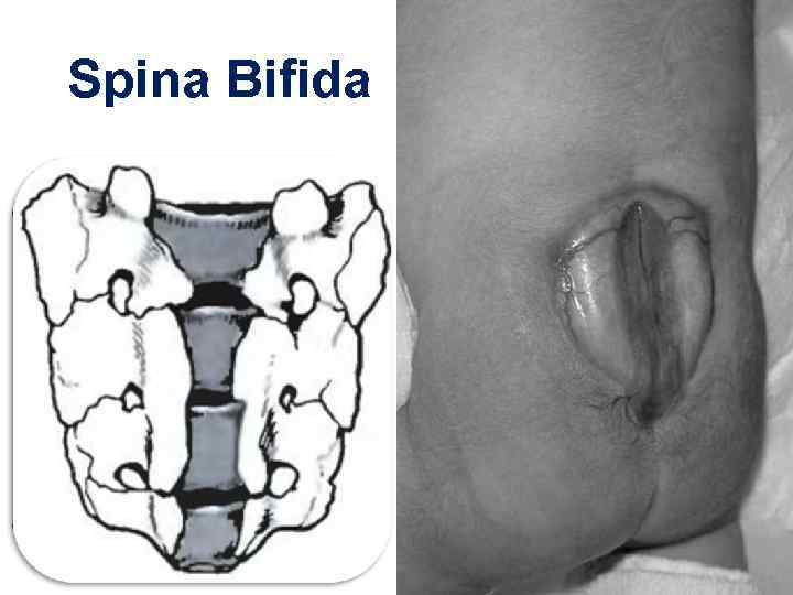 Spina Bifida 29 