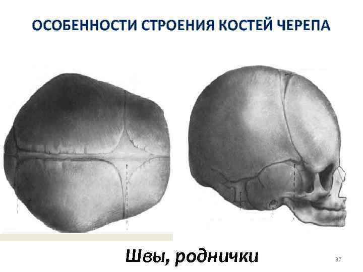 Стреловидный шов фото