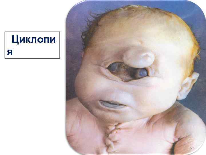  Циклопия WЦиклопи я 53 