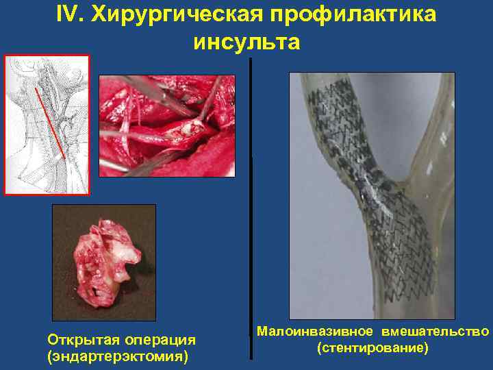 IV. Хирургическая профилактика инсульта Малоинвазивное вмешательство Открытая операция (стентирование) (эндартерэктомия) 