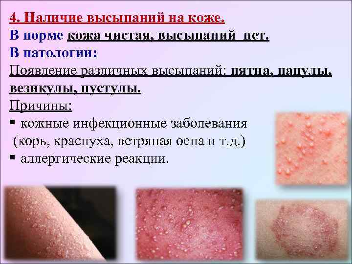4. Наличие высыпаний на коже. В норме кожа чистая, высыпаний нет. В патологии: Появление
