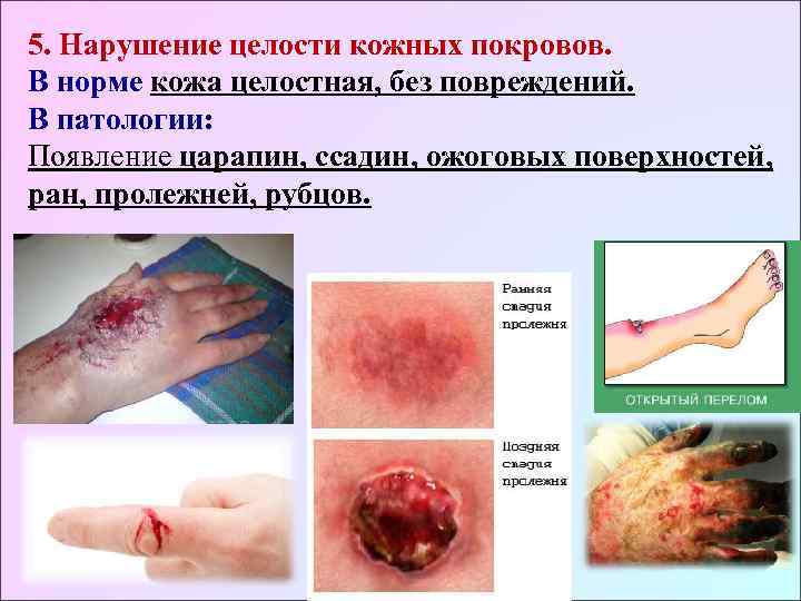 5. Нарушение целости кожных покровов.  В норме кожа целостная, без повреждений. В патологии: