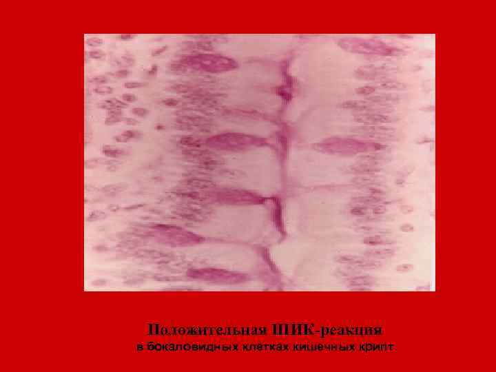  Положительная ШИК-реакция в бокаловидных клетках кишечных крипт. 