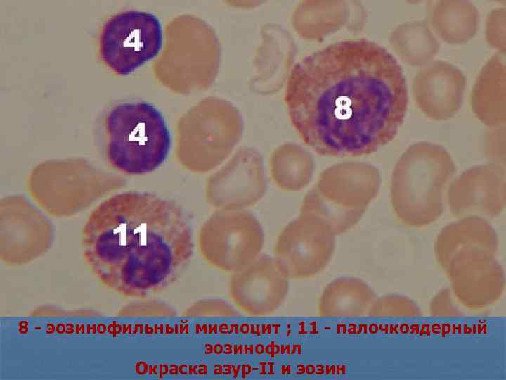 8 - эозинофильный миелоцит ; 11 - палочкоядерный эозинофил Окраска азур-II и эозин 