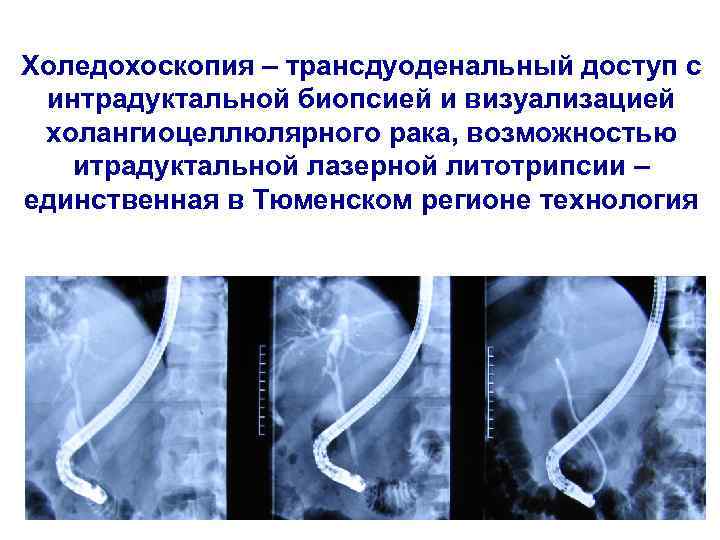 Холедохоскопия – трансдуоденальный доступ с интрадуктальной биопсией и визуализацией холангиоцеллюлярного рака, возможностью итрадуктальной лазерной