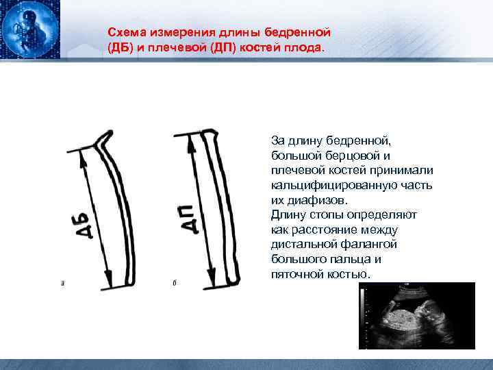 Схема измерения длины бедренной (ДБ) и плечевой (ДП) костей плода. За длину бедренной, большой