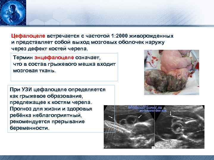 Цефалоцеле встречается с частотой 1: 2000 живорожденных и представляет собой выход мозговых оболочек наружу