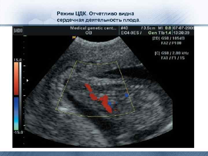 Режим ЦДК. Отчетливо видна сердечная деятельность плода. 