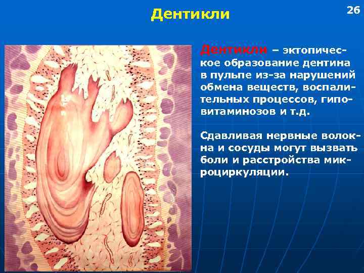      26 Дентикли – эктопичес- кое образование дентина в пульпе