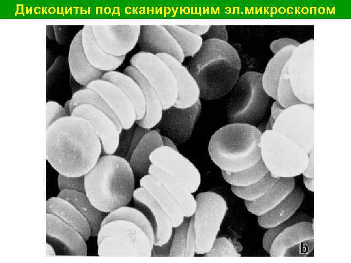 Атипичные эритроциты Атипичные эритроциты