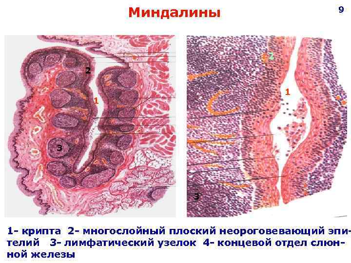  Миндалины 9 2 1 3 3 1 - крипта 2 - многослойный плоский