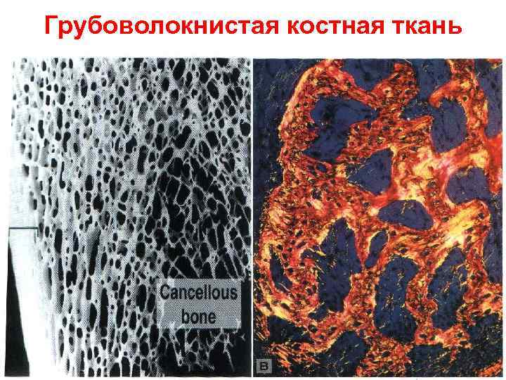 Грубоволокнистая костная ткань 