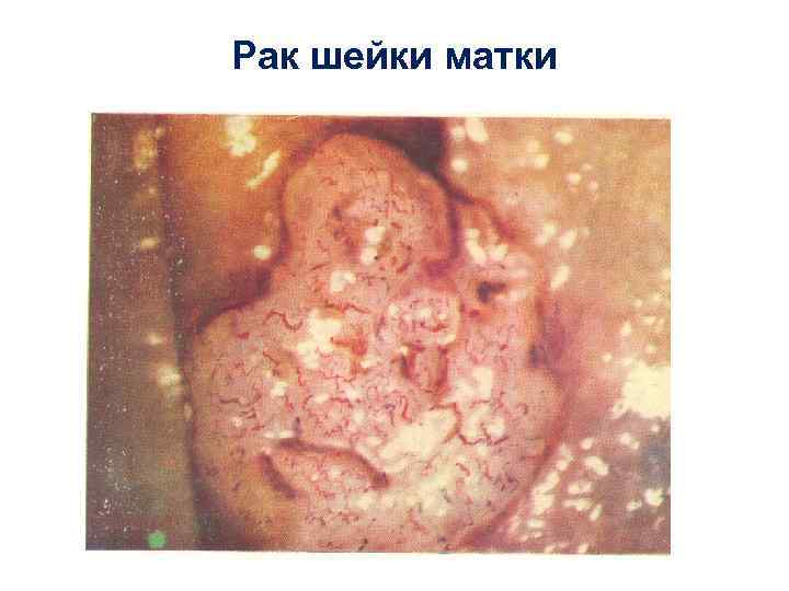 Рак шейки матки 