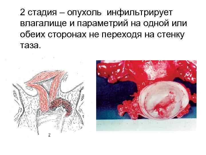 2 стадия – опухоль инфильтрирует влагалище и параметрий на одной или обеих сторонах не