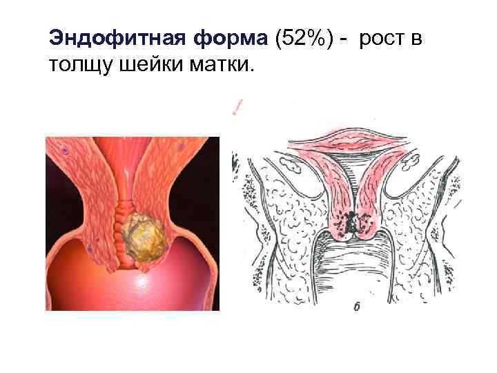 Эндофитная форма (52%) - рост в толщу шейки матки. 