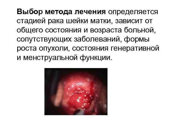Выбор метода лечения определяется стадией рака шейки матки, зависит от общего состояния и возраста