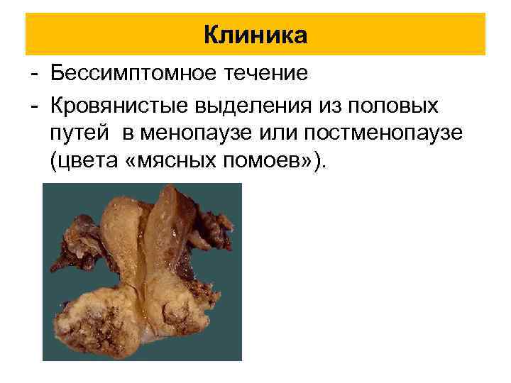  Клиника - Бессимптомное течение - Кровянистые выделения из половых путей в менопаузе или