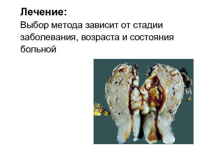 Лечение: Выбор метода зависит от стадии заболевания, возраста и состояния больной 