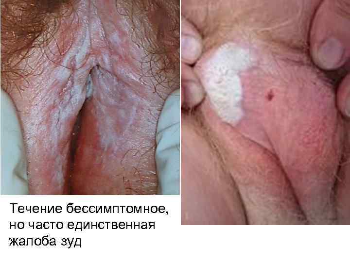 Течение бессимптомное, но часто единственная жалоба зуд 