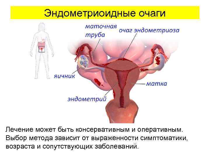  Эндометриоидные очаги Лечение может быть консервативным и оперативным. Выбор метода зависит от выраженности