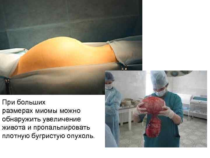 При больших размерах миомы можно обнаружить увеличение живота и пропальпировать плотную бугристую опухоль. 