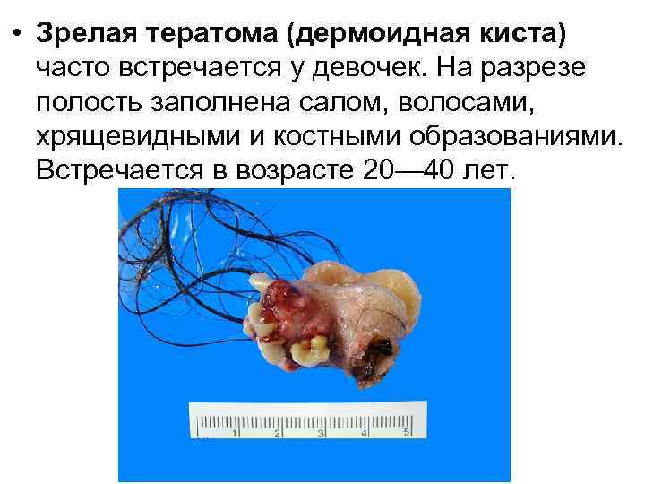  • Зрелая тератома (дермоидная киста) часто встречается у девочек. На разрезе полость заполнена