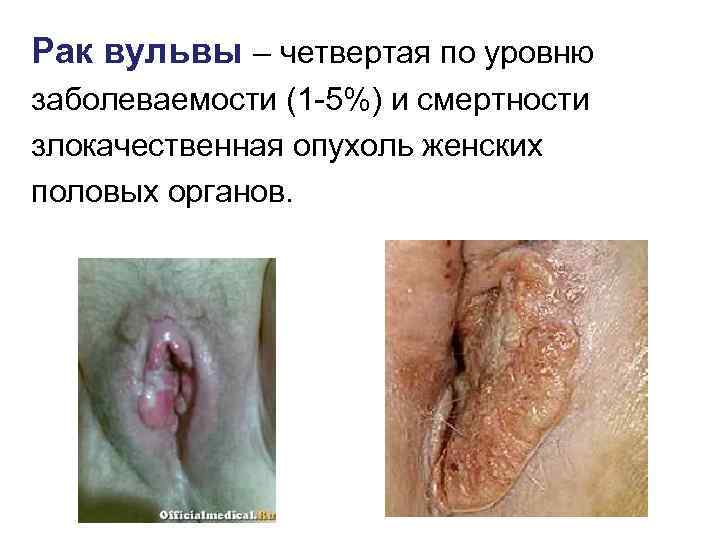 Рак вульвы – четвертая по уровню заболеваемости (1 -5%) и смертности злокачественная опухоль женских