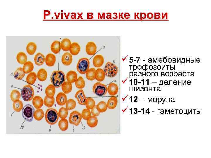 P. vivax в мазке крови ü 5 -7 - амебовидные трофозоиты разного возраста ü