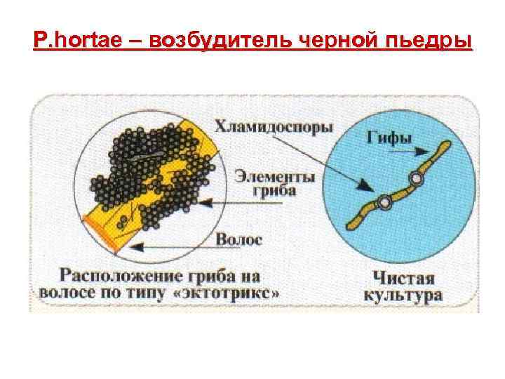 P. hortae – возбудитель черной пьедры 