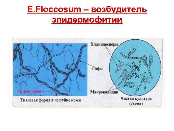 E. Floccosum – возбудитель эпидермофитии 