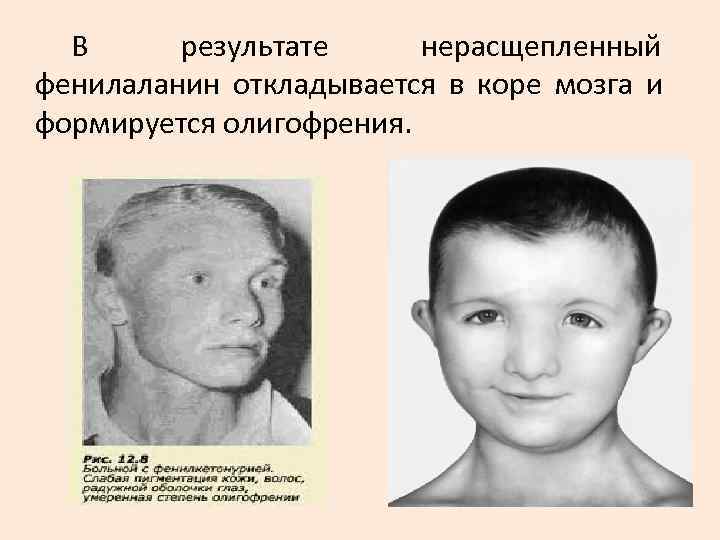 В результате нерасщепленный фенилаланин откладывается в коре мозга и формируется олигофрения. В результате нерасщепленный фенилаланин откладывается в коре мозга и формируется олигофрения.