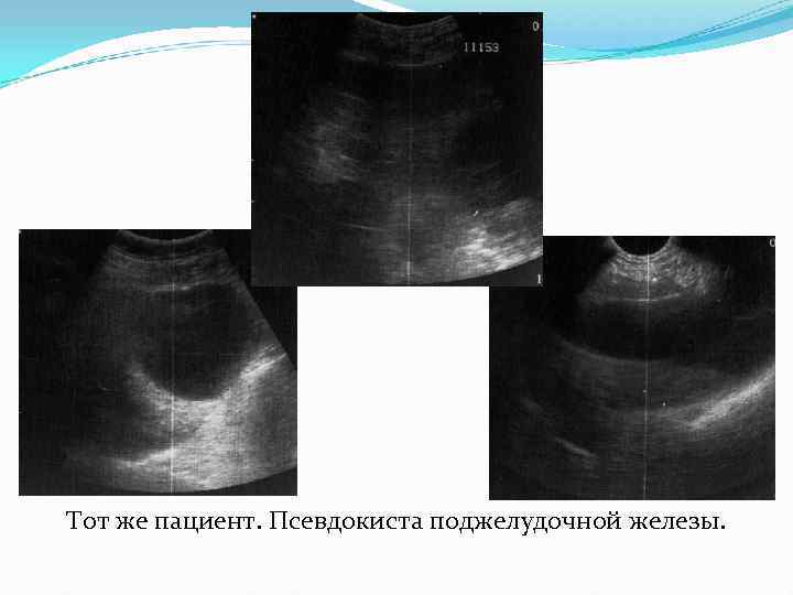 Тот же пациент. Псевдокиста поджелудочной железы. 