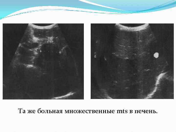 Та же больная множественные mts в печень. 