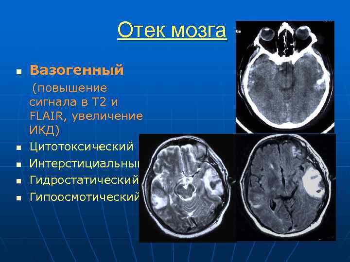  Отек мозга n Вазогенный (повышение сигнала в Т 2 и FLAIR, увеличение ИКД)