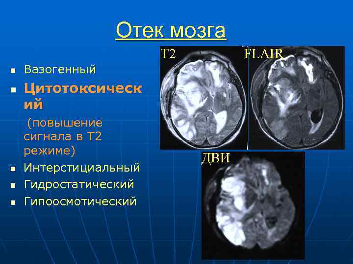 Отек мозга Т 2 FLAIR n Вазогенный n Цитотоксическ ий (повышение сигнала в