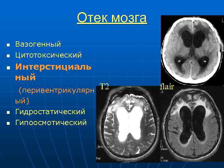  Отек мозга n Вазогенный n Цитотоксический n Интерстициаль ный (перивентрикулярн Т 2 flair