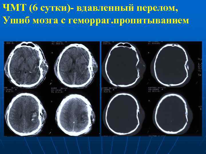 ЧМТ (6 сутки)- вдавленный перелом, Ушиб мозга с геморраг. пропитыванием 