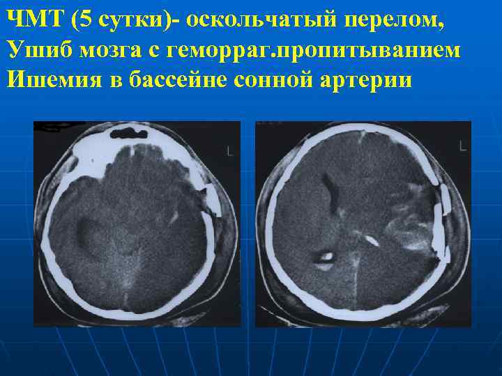 ЧМТ (5 сутки)- оскольчатый перелом, Ушиб мозга с геморраг. пропитыванием Ишемия в бассейне сонной