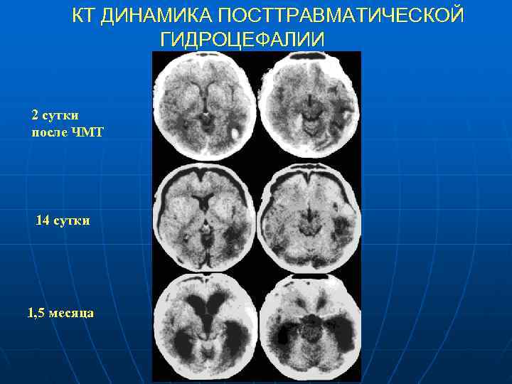  КТ ДИНАМИКА ПОСТТРАВМАТИЧЕСКОЙ ГИДРОЦЕФАЛИИ 2 сутки после ЧМТ 14 сутки 1, 5 месяца