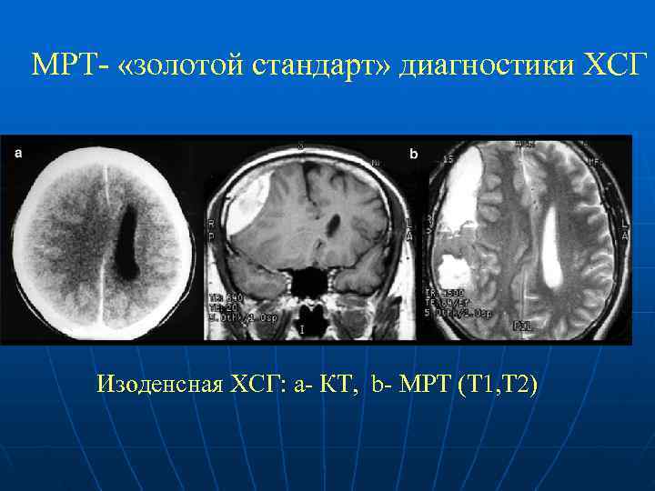 МРТ- «золотой стандарт» диагностики ХСГ Изоденсная ХСГ: а- КТ, b- МРТ (Т 1, Т