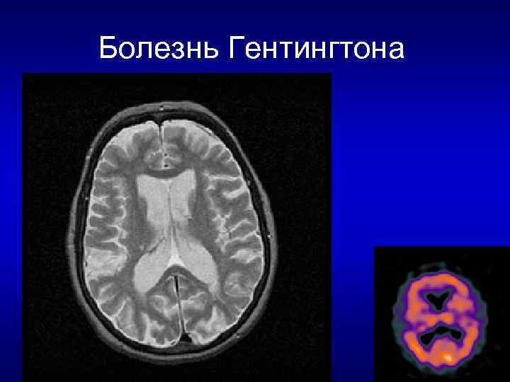 Болезнь Гентингтона 