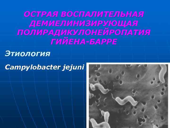  ОСТРАЯ ВОСПАЛИТЕЛЬНАЯ ДЕМИЕЛИНИЗИРУЮЩАЯ ПОЛИРАДИКУЛОНЕЙРОПАТИЯ ГИЙЕНА-БАРРЕ Этиология Campylobacter jejuni 