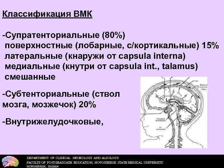 Классификация ВМК  Супратенториальные (80%) поверхностные (лобарные, с/кортикальные) 15% латеральные (кнаружи от capsula interna)