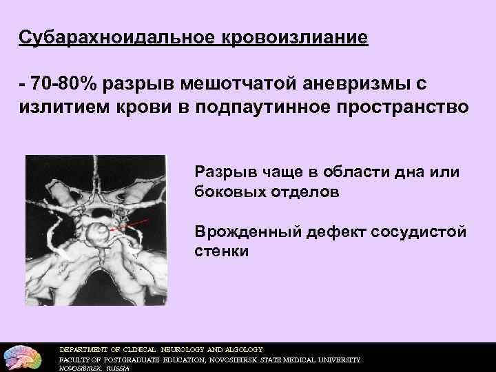 Субарахноидальное кровоизлиание - 70 -80% разрыв мешотчатой аневризмы с излитием крови в подпаутинное пространство