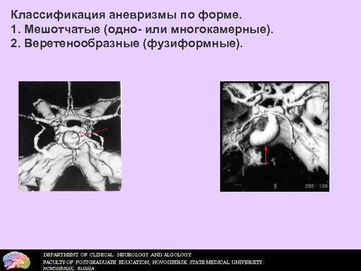Классификация аневризмы по форме. 1. Мешотчатые (одно- или многокамерные). 2. Веретенообразные (фузиформные).  