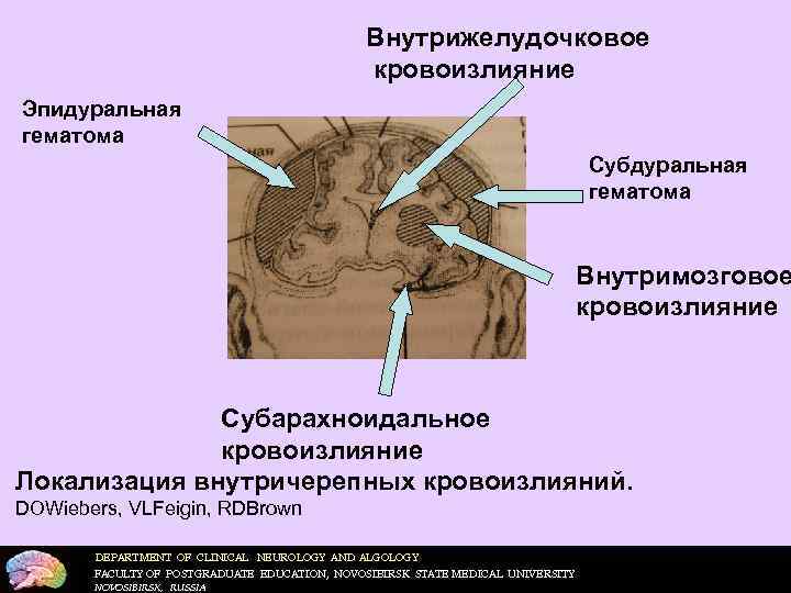     Внутрижелудочковое    кровоизлияние Эпидуральная гематома   