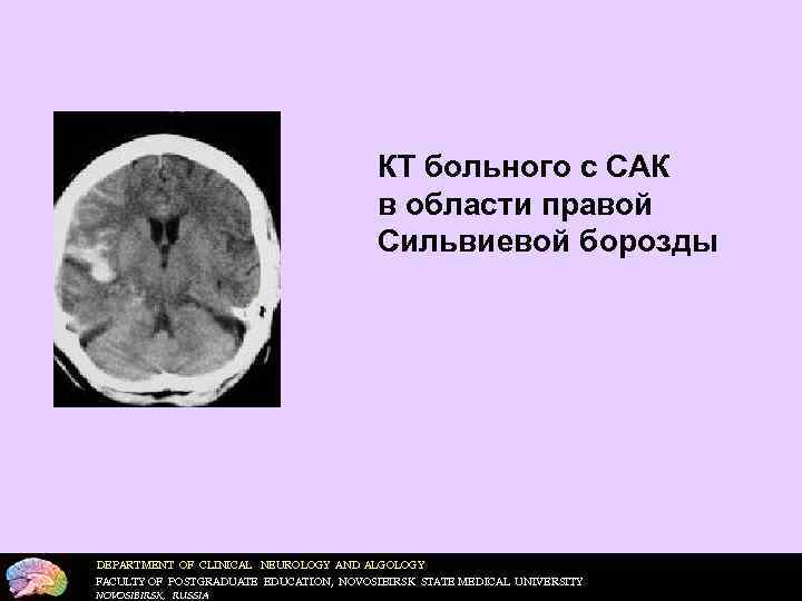        КТ больного с САК   