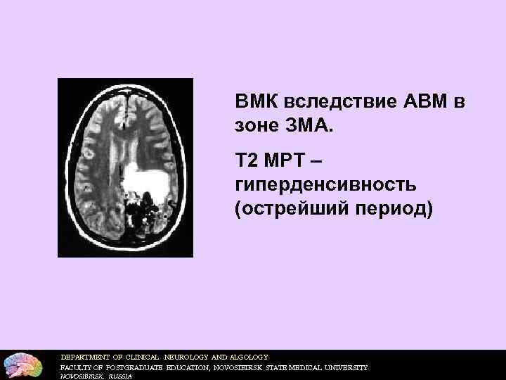     ВМК вследствие АВМ в      