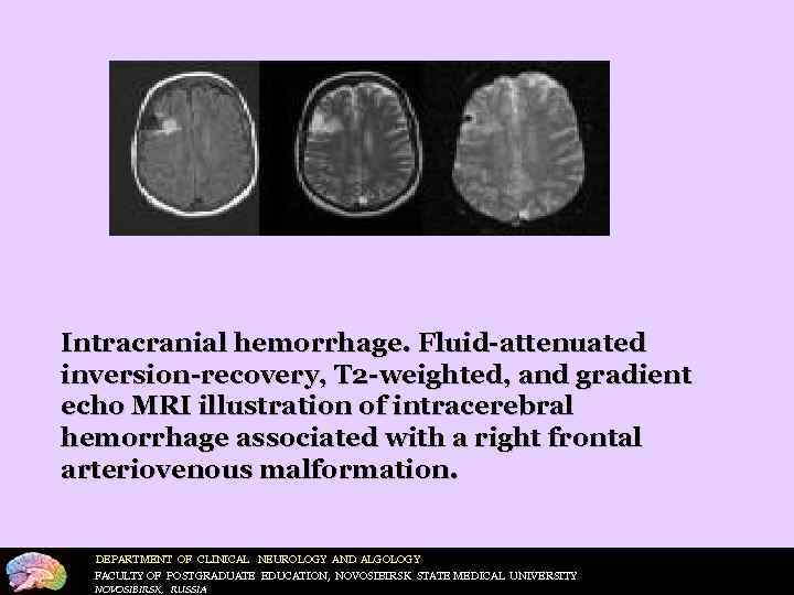Intracranial hemorrhage. Fluid-attenuated inversion-recovery, T 2 -weighted, and gradient echo MRI illustration of intracerebral