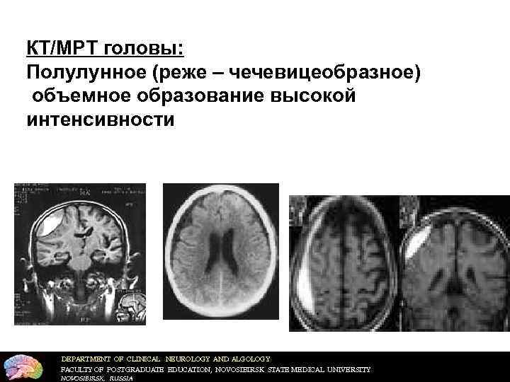 КТ/МРТ головы: Полулунное (реже – чечевицеобразное) объемное образование высокой интенсивности  DEPARTMENT OF CLINICAL
